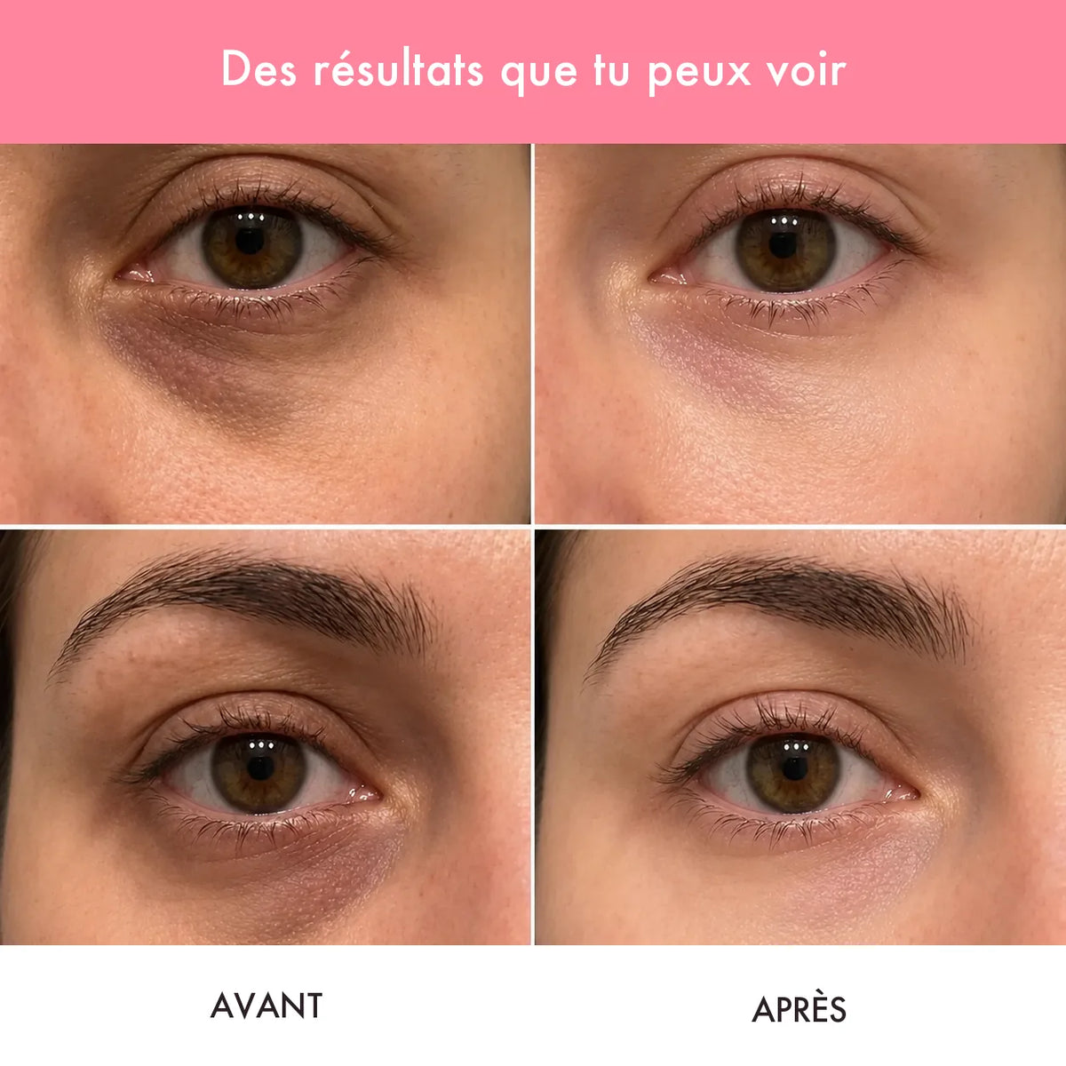 Avant / après : contour des yeux plus lisse et moins creusé