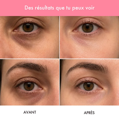 Avant / après : contour des yeux plus lisse et moins creusé
