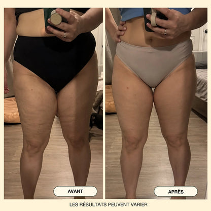 Avant / après : cuisses vues de face, peau plus lisse