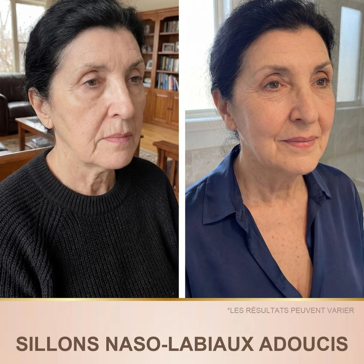 Avant / après : sillons naso-labiaux adoucis