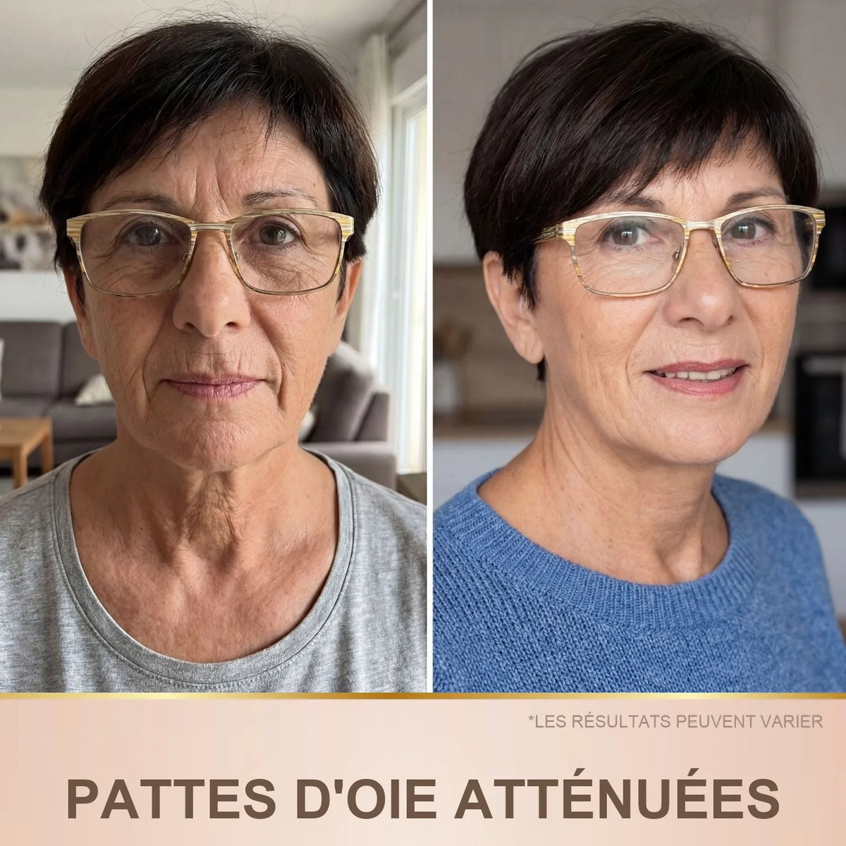 Avant / après : pattes d’oie atténuées
