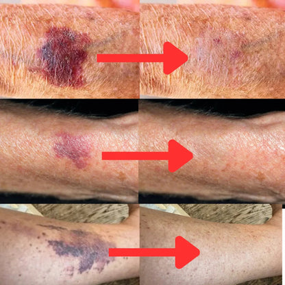 Avant-bras avant et après : taches violettes estompées