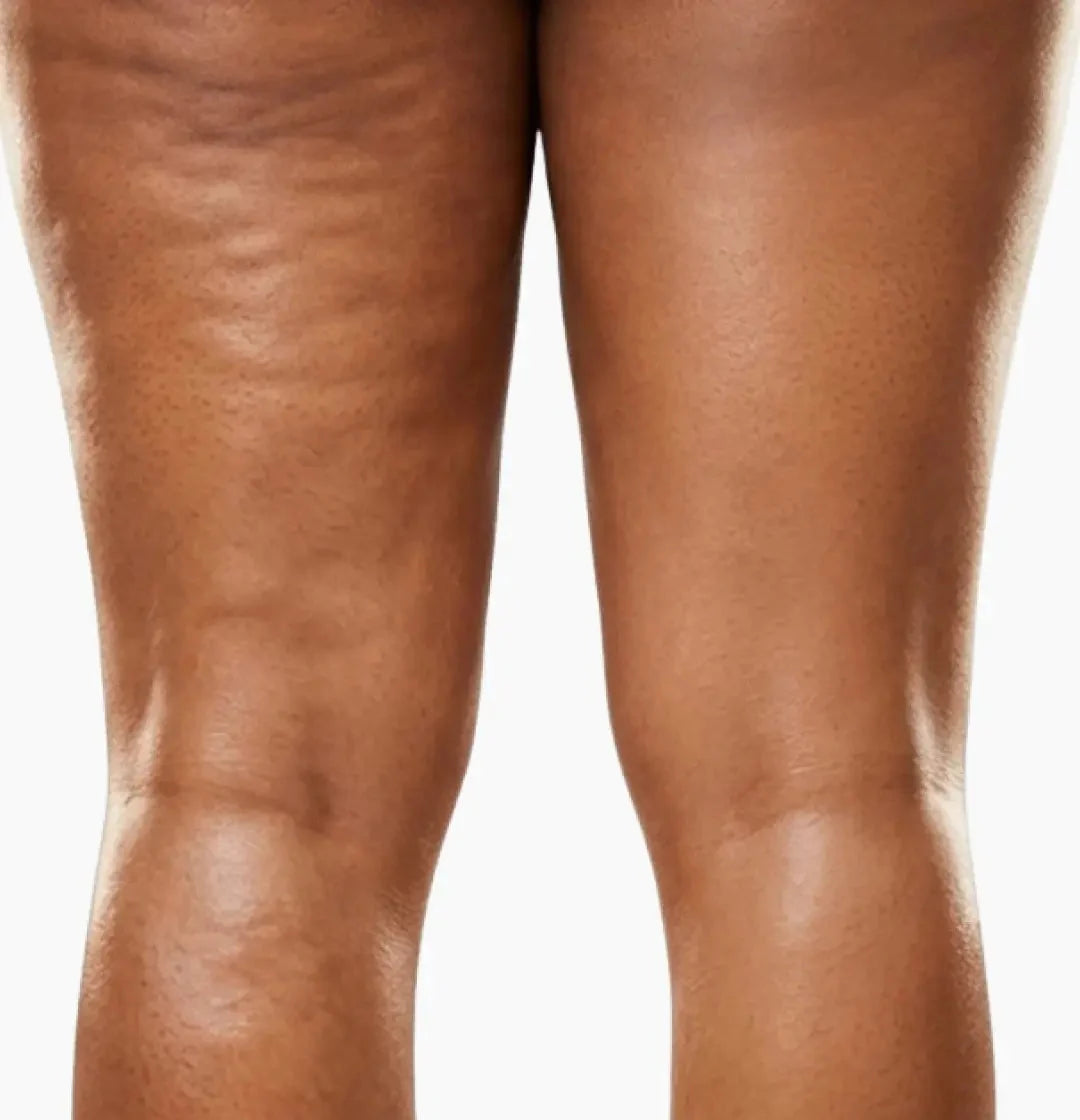 Jambes au jour 1 et au jour 14