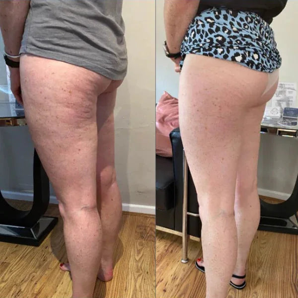 Cuisses, avant et apr&egrave;s